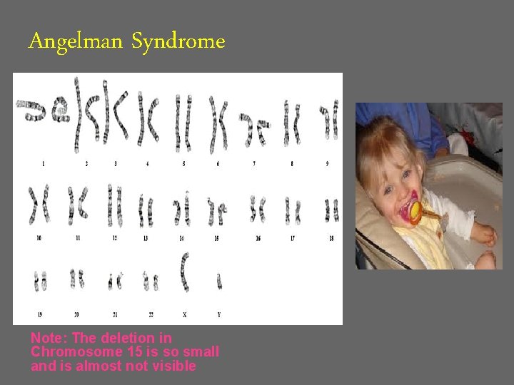 Angelman Syndrome Note: The deletion in Chromosome 15 is so small and is almost