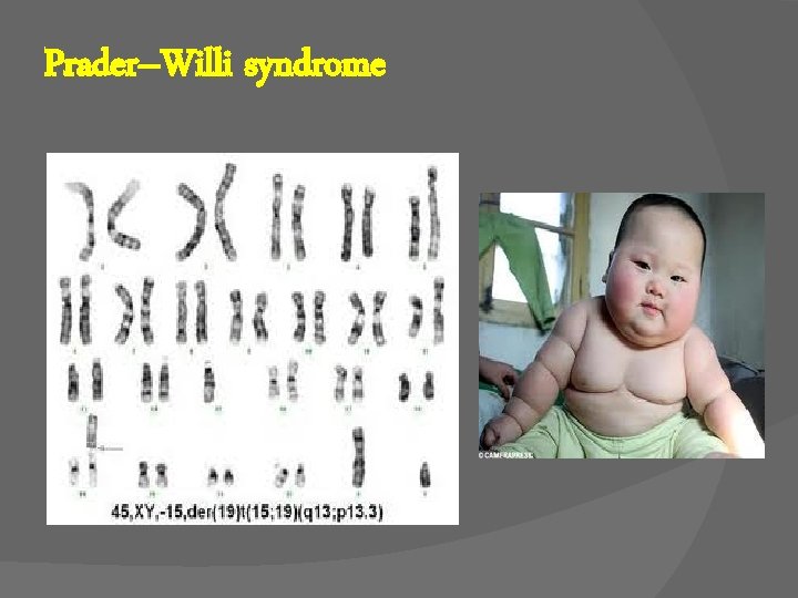 Prader–Willi syndrome 