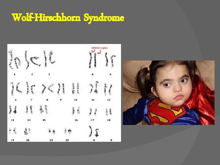 Wolf-Hirschhorn Syndrome 