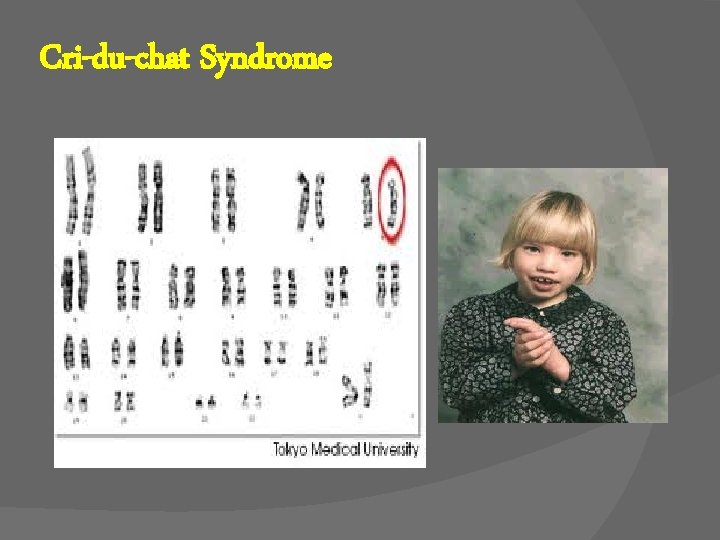 Cri-du-chat Syndrome 