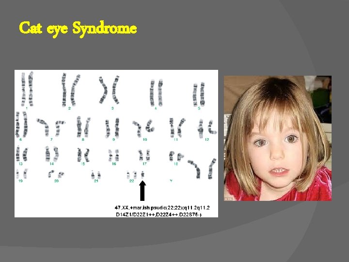 Cat eye Syndrome 