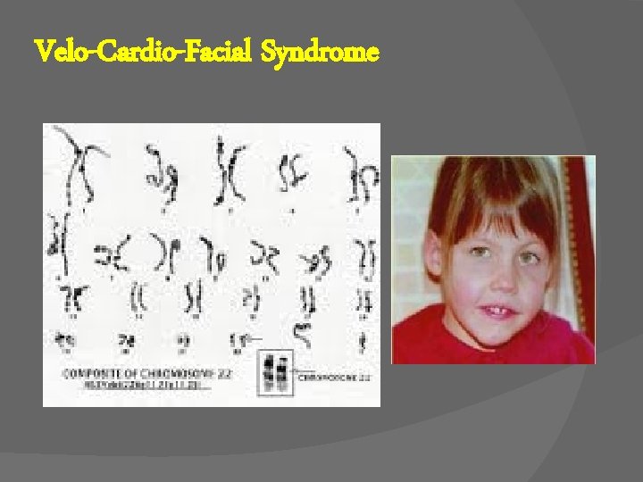 Velo-Cardio-Facial Syndrome 