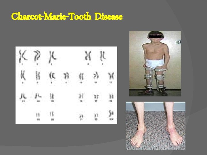 Charcot-Marie-Tooth Disease 