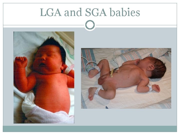 LGA and SGA babies 