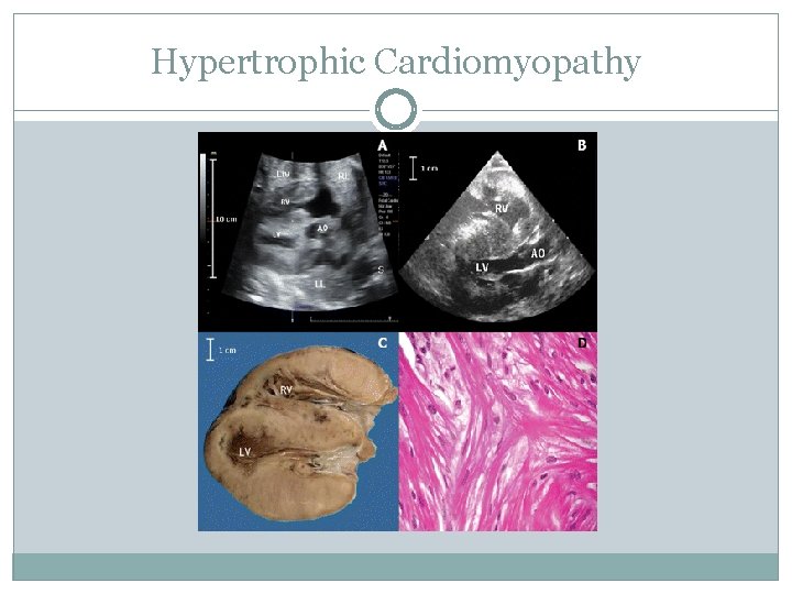 Hypertrophic Cardiomyopathy 