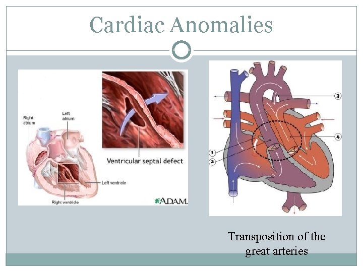 Cardiac Anomalies Transposition of the great arteries 