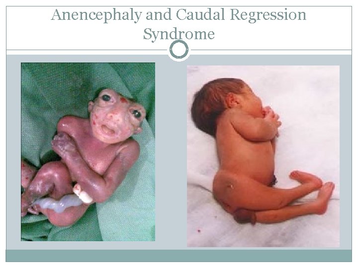 Anencephaly and Caudal Regression Syndrome 