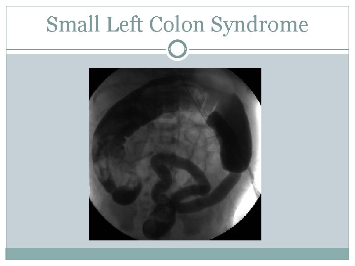 Small Left Colon Syndrome 