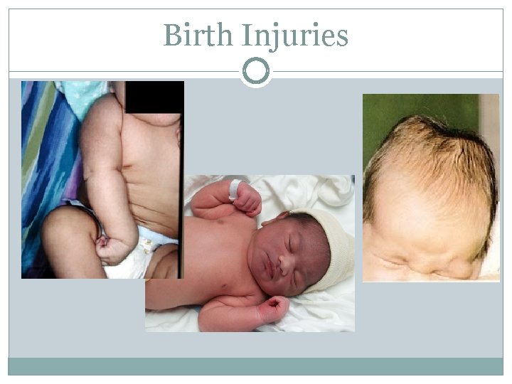 Birth Injuries 