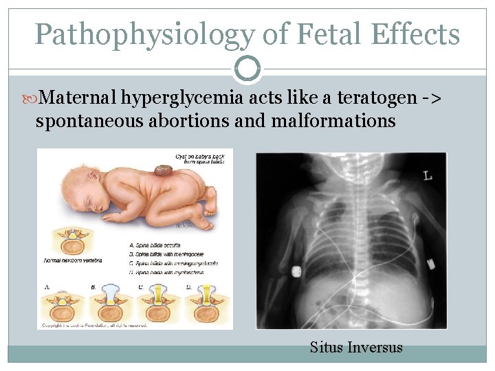 Pathophysiology of Fetal Effects Maternal hyperglycemia acts like a teratogen -> spontaneous abortions and