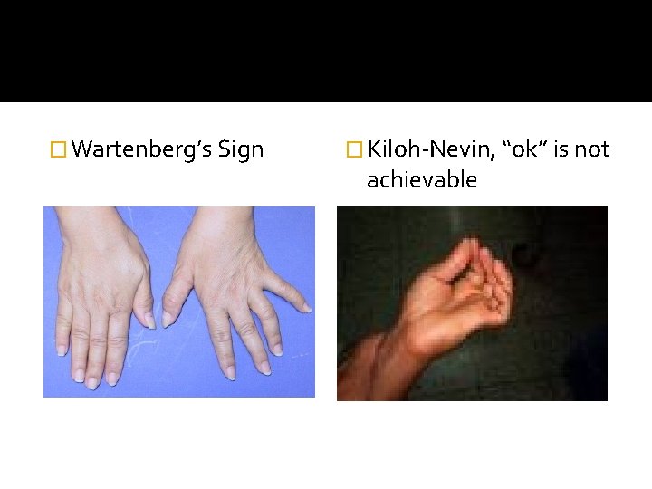 � Wartenberg’s Sign � Kiloh-Nevin, “ok” is not achievable 