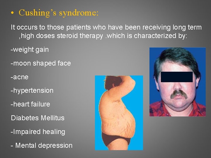  • Cushing’s syndrome: It occurs to those patients who have been receiving long