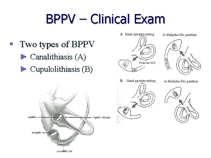 BPPV – Clinical Exam § Two types of BPPV ► Canalithiasis (A) ► Cupulolithiasis