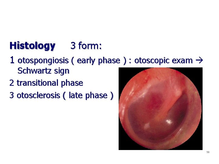 Histology 3 form: 1 otospongiosis ( early phase ) : otoscopic exam Schwartz sign