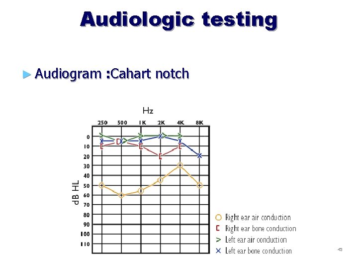 Audiologic testing ► Audiogram : Cahart notch 43 