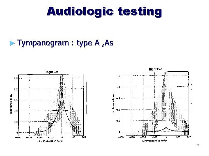 Audiologic testing ► Tympanogram : type A , As 44 