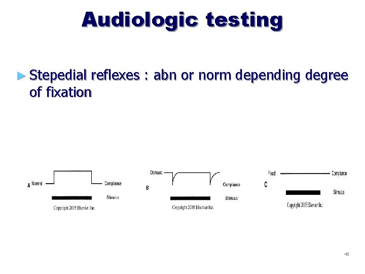 Audiologic testing ► Stepedial reflexes : abn or norm depending degree of fixation 45