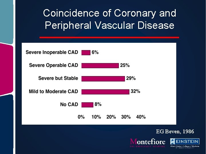 Coincidence of Coronary and Peripheral Vascular Disease EG Beven, 1986 