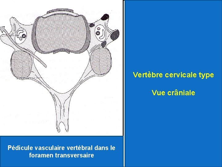 Vertèbre cervicale type Vue crâniale Pédicule vasculaire vertébral dans le foramen transversaire 