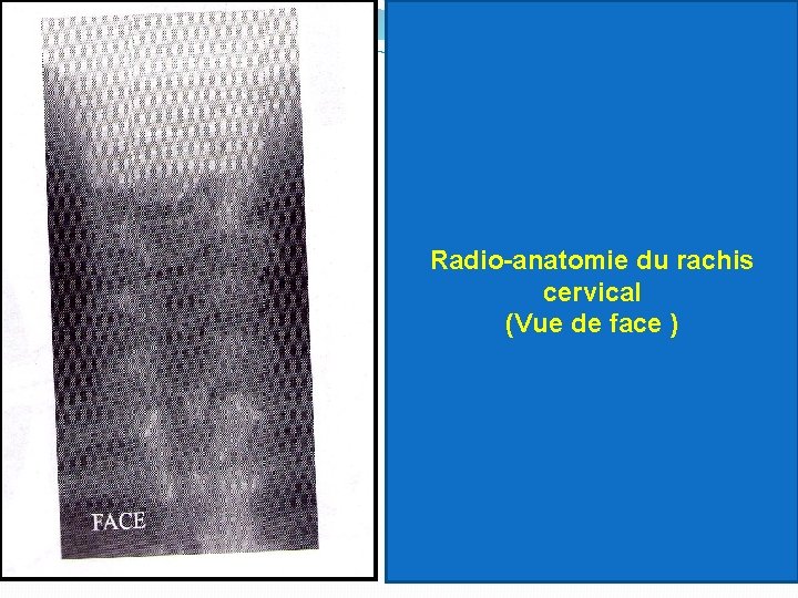 Radio-anatomie du rachis cervical (Vue de face ) 