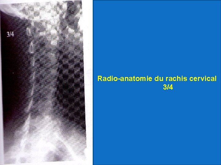 Radio-anatomie du rachis cervical 3/4 