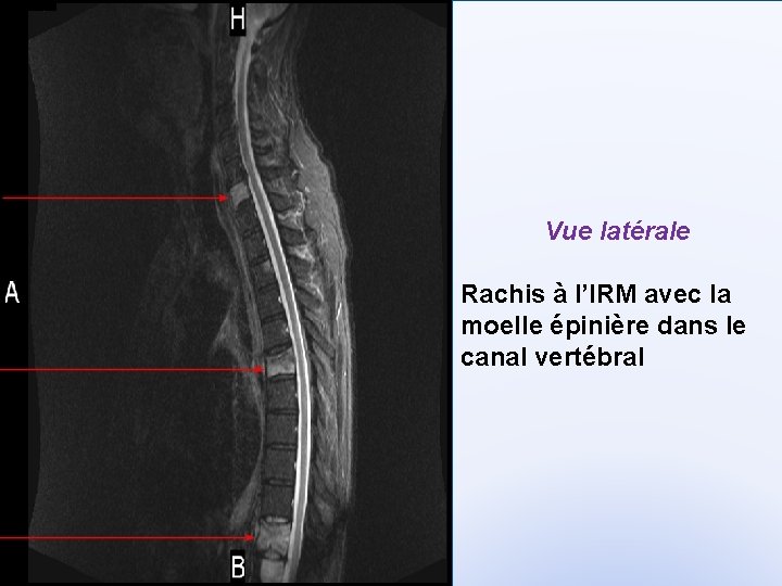 Vue latérale Rachis à l’IRM avec la moelle épinière dans le canal vertébral 