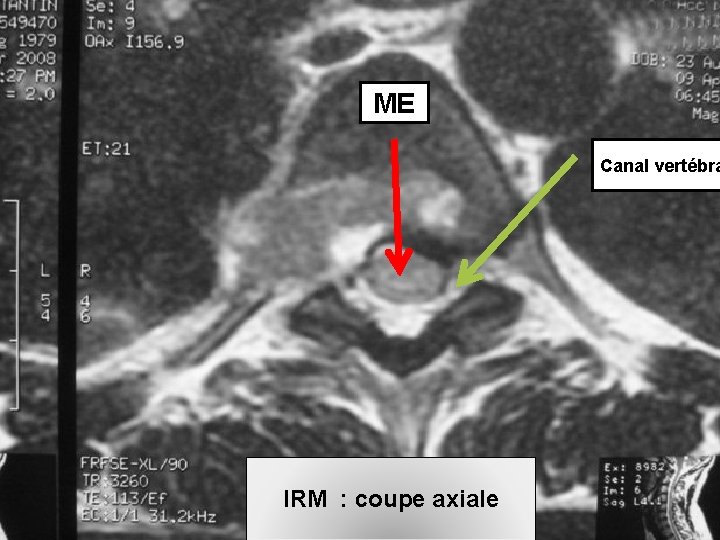 ME Canal vertébra IRM : coupe axiale 