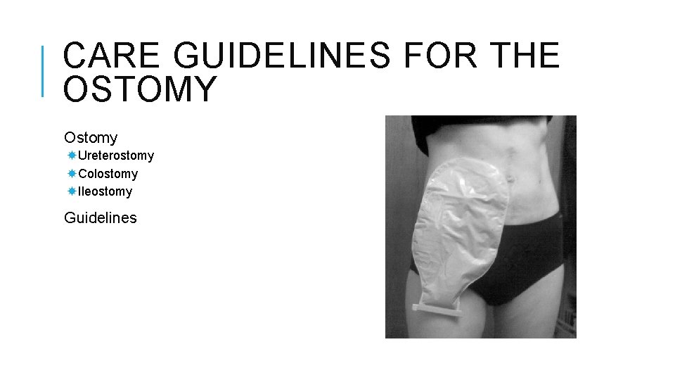 CARE GUIDELINES FOR THE OSTOMY Ostomy Ureterostomy Colostomy Ileostomy Guidelines 