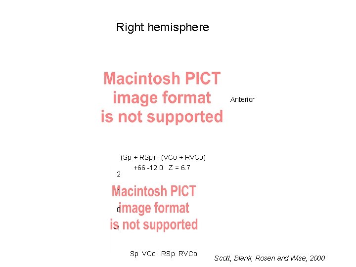 Right hemisphere Anterior 2 (Sp + RSp) - (VCo + RVCo) +66 -12 0