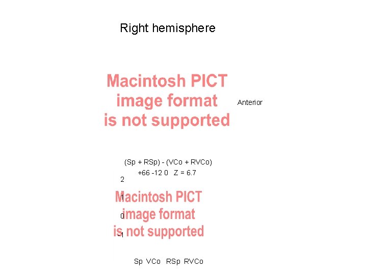 Right hemisphere Anterior 2 (Sp + RSp) - (VCo + RVCo) +66 -12 0