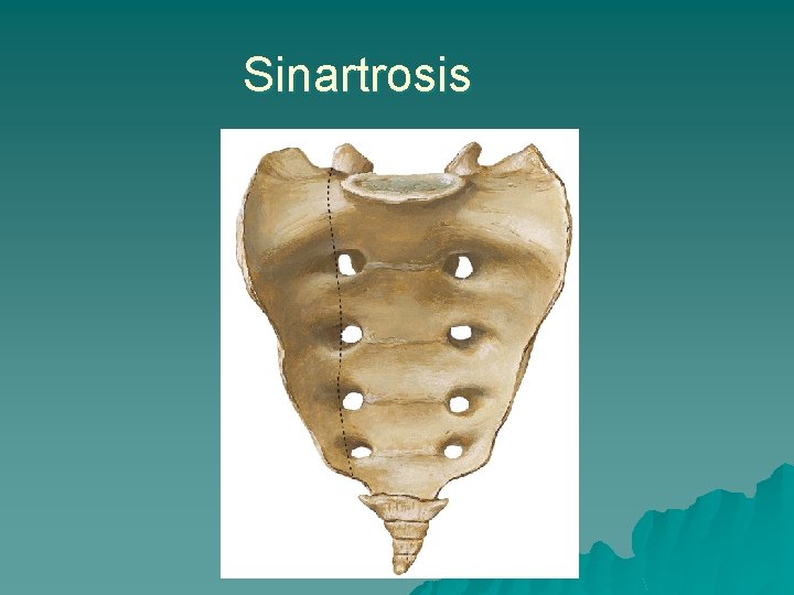 Sinartrosis 