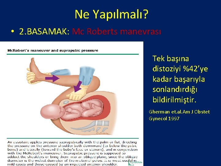 Ne Yapılmalı? • 2. BASAMAK: Mc Roberts manevrası Tek başına distoziyi %42’ye kadar başarıyla