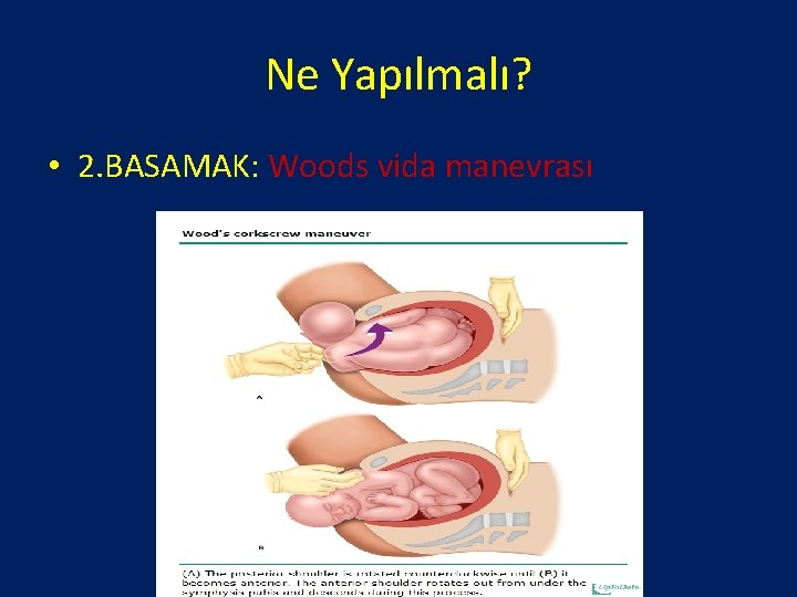 Ne Yapılmalı? • 2. BASAMAK: Woods vida manevrası 