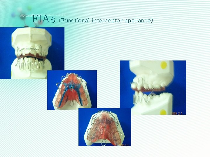 FIAs (Functional interceptor appliance) 