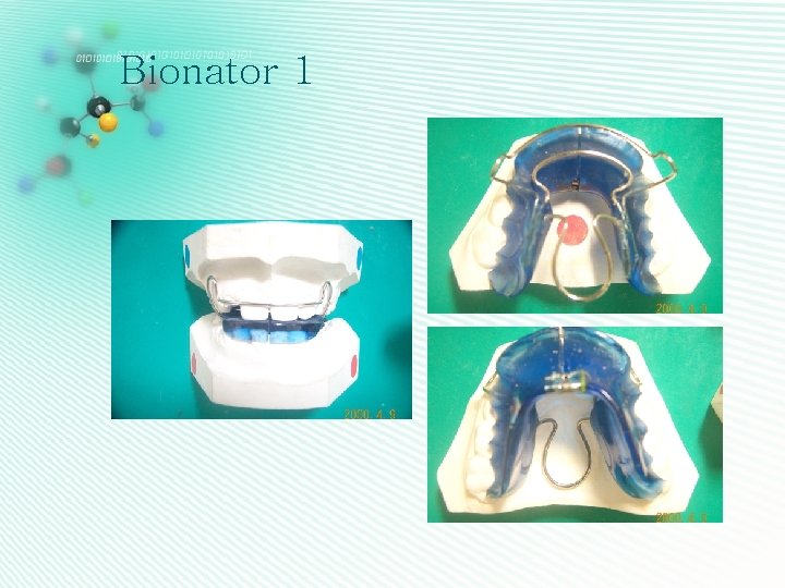 Bionator 1 