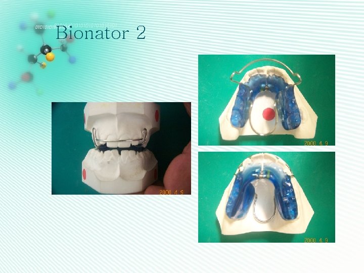Bionator 2 