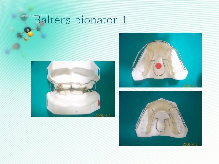 Balters bionator 1 