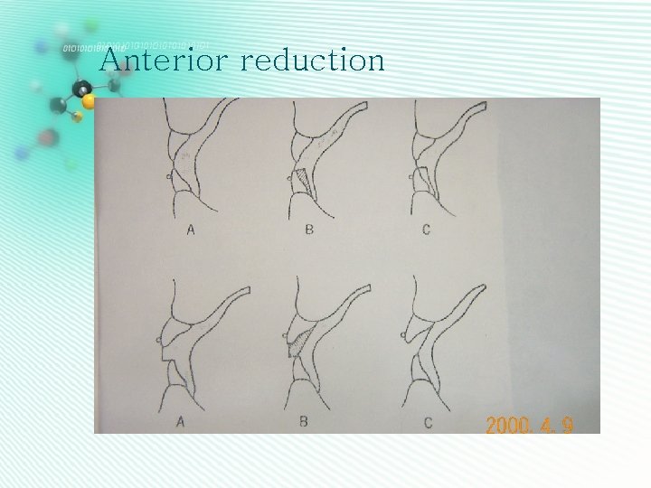 Anterior reduction 