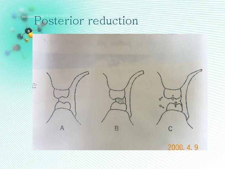 Posterior reduction 