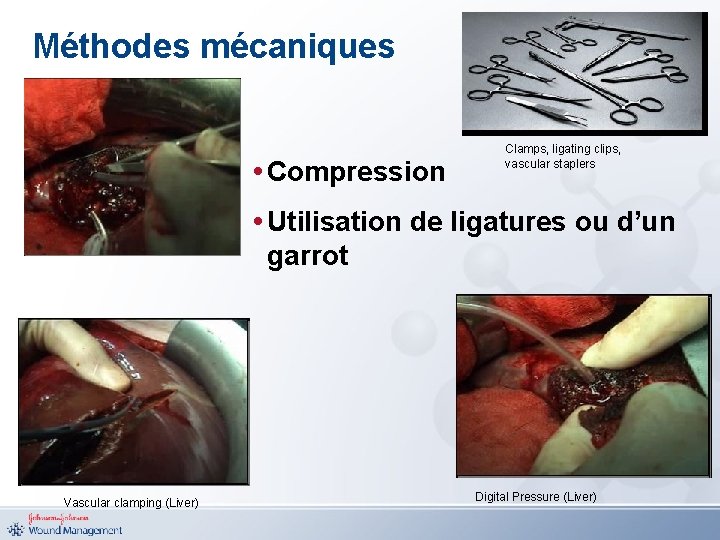Méthodes mécaniques • Compression Clamps, ligating clips, vascular staplers • Utilisation de ligatures ou