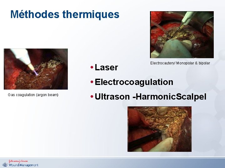 Méthodes thermiques • Laser Electrocautery/ Monopolar & bipolar • Electrocoagulation Gas coagulation (argon beam)