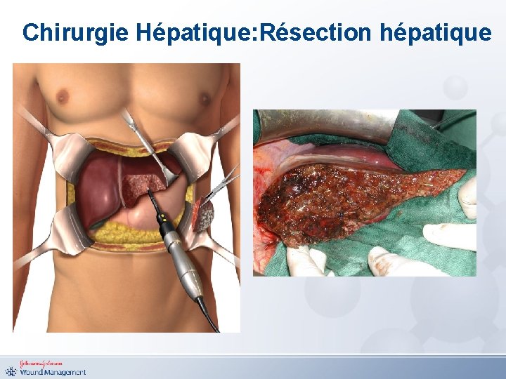 Chirurgie Hépatique: Résection hépatique 