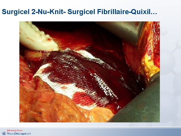 Surgicel 2 -Nu-Knit- Surgicel Fibrillaire-Quixil… 