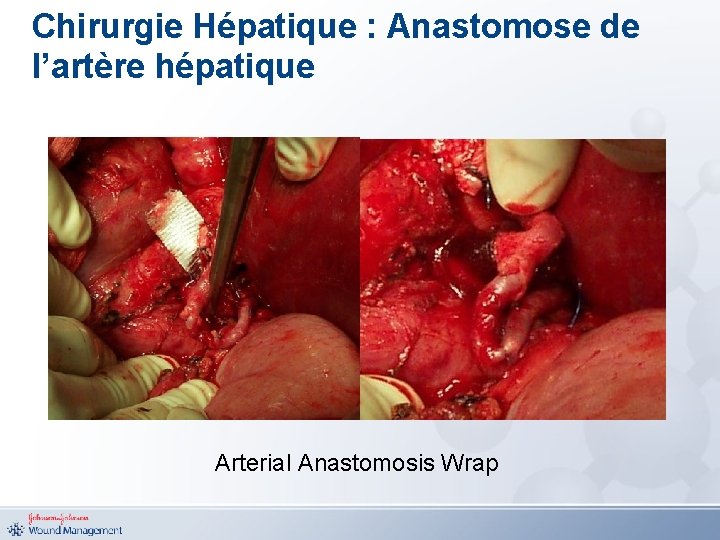 Chirurgie Hépatique : Anastomose de l’artère hépatique Arterial Anastomosis Wrap 