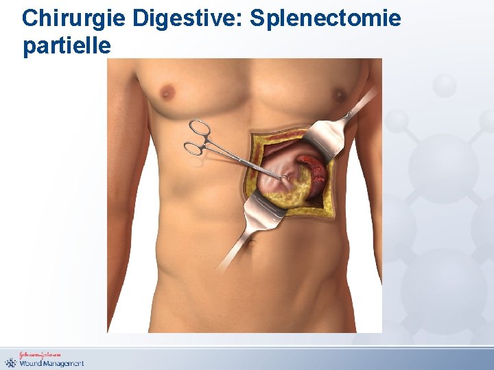 Chirurgie Digestive: Splenectomie partielle 