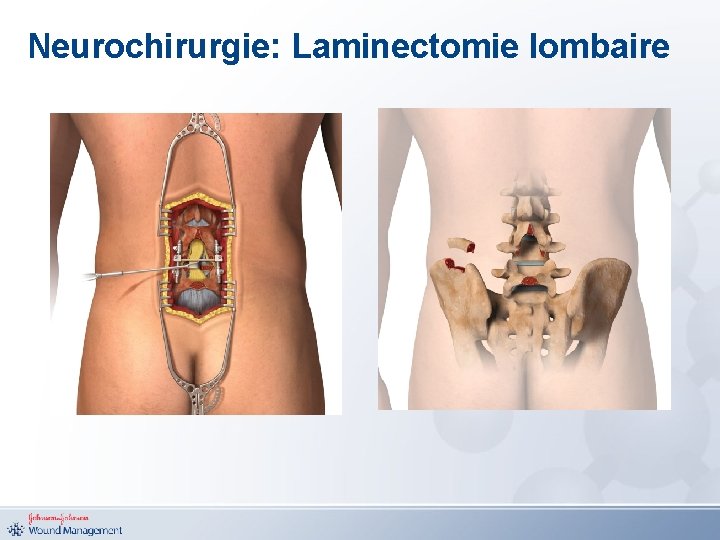 Neurochirurgie: Laminectomie lombaire 