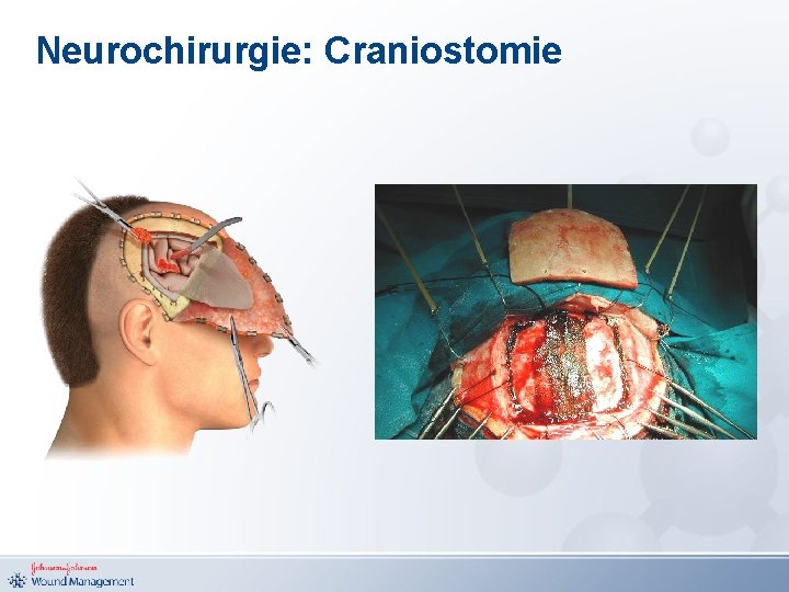 Neurochirurgie: Craniostomie 