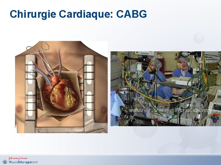 Chirurgie Cardiaque: CABG 