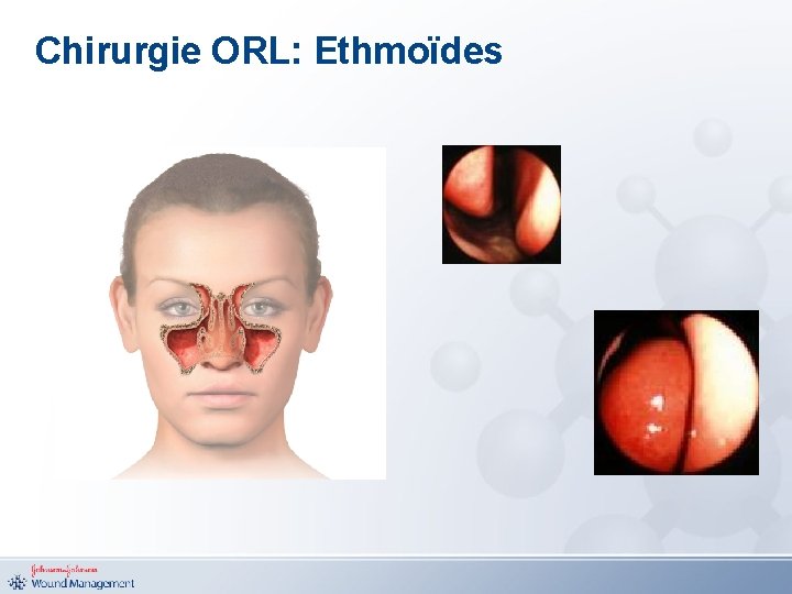 Chirurgie ORL: Ethmoïdes 