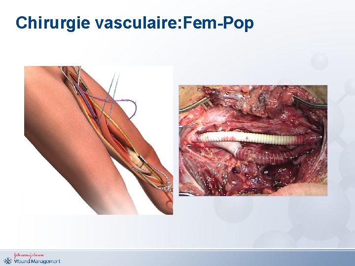 Chirurgie vasculaire: Fem-Pop 